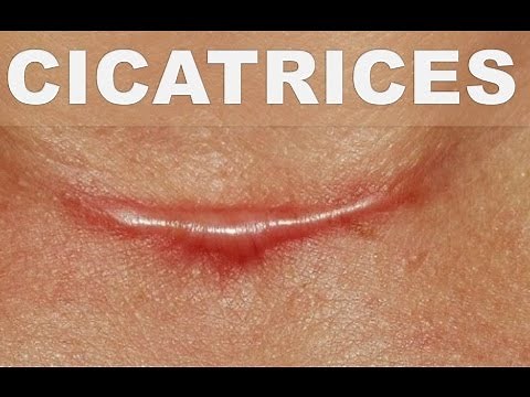 ☞ Receta casera para combatir cicatrices – Como desvanecer las cicatrices en la piel