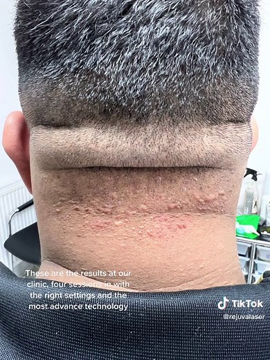 Understanding Folliculitis: Causes and Solutions