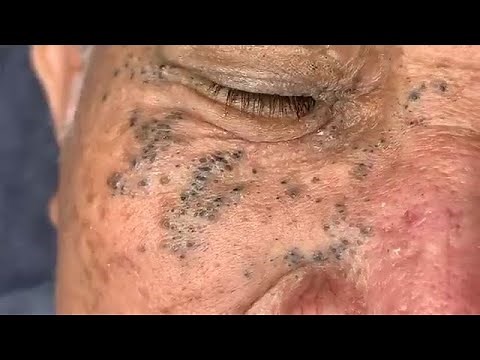 Dr Pop - Deep Blackheads in old Skin removing & treatment 2020 (Last PART 10)