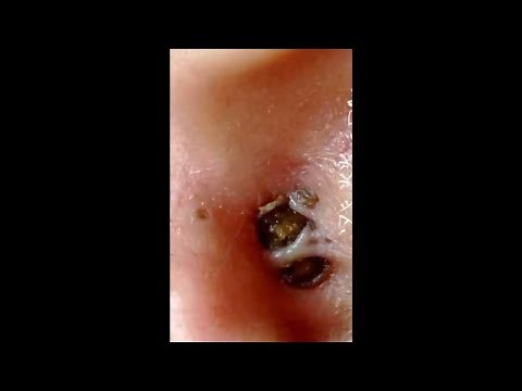 Ear BlackHeads Removed With GIANT Extraction (Blackheads Removal Videos 2022) / #8