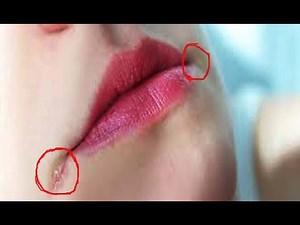 Home Remedies For Angular Cheilitis Cracks in Corners of Mouth