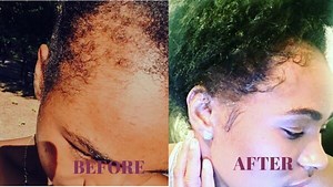 How to Regrow Hairline Fast & Boost Your Natural 4C Edges [It Works]