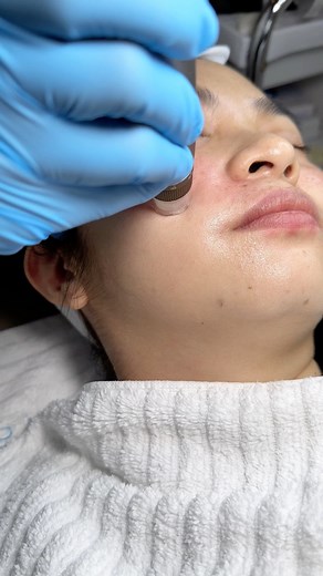 One of the many treatments to help reduce melasma is Microneedling infused with Anteage Tranexamic. PM us to book for consultation. #MelasmaTreatment #AnteAgeBrightener #Tranexamic #GrowthFactors #Microneedling #NouvelleClinic | Nouvelle Clinic Face and Body Angeles City Branch | Facebook