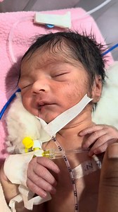 93K views · 635 reactions | Adorable Baby NG Tube Removal Procedure #NGTubeRemoval #NasogastricTube #NewbornCare #NICUBaby | Anoop Gautam | Facebook