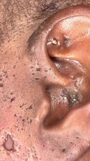 4 - beautiful ear blackheads removal #ingrownhairpro #pimples #blackheads #satisfying