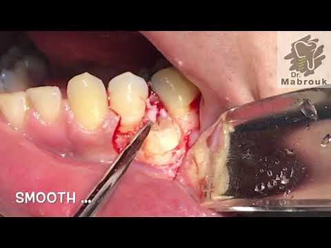 Impacted Premolar