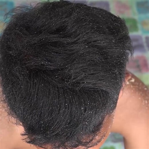 Dandruff Big Flakes Satisfying Removal Worms On In Biggest Hole #2107 Part 13 | Help remove ticks