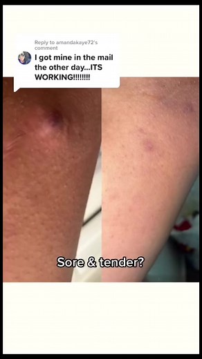 44K views · 287 reactions | The link to purchase is in my Stan store linked in my bio  #hidradenitissuppurativa #hswarrior #hsawareness #hidradenitissuppurativawarrior #socialcydd | Cydney Carter | Facebook