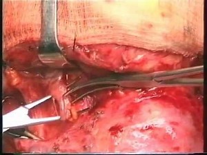 Functional neck dissection using the fascial plane technique: J Gavilán