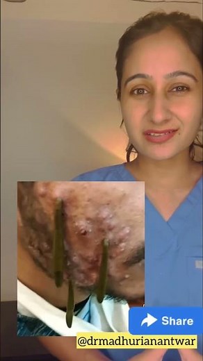 Acne leech therapy!Does it work?