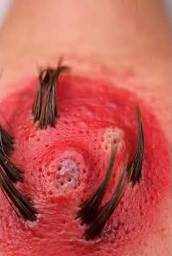 Cluster Blackhead removal, pimple popping and ingrown hair series.