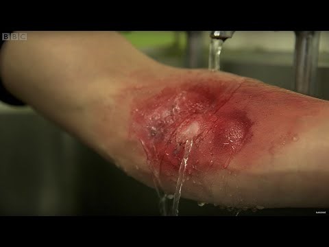 How You Should Treat A Serious Burn | Earth Science