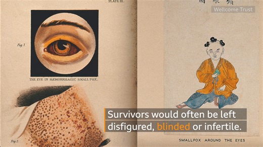 39 reactions | Smallpox was one of the biggest killers in the history of humanity. This is the story of how we eradicated it, and what lessons this might hold for us now: | The Royal Society | Facebook