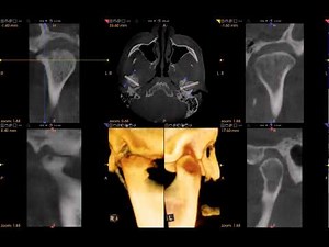 3-D Scan of TMJ • Video • MEDtube.net