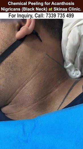 Chemical peeling for acanthosis nigricans (black neck) at skinaa clinic #chemicalpeel #chemicalpeeltreatment #acanthosisnigricans #reels #viral #skinaa_clinic #skinaaclinic #explore #foryou #blackneck #blacknecktreatment | Skinaa - Skin, Laser, and Hair Transplant Clinic