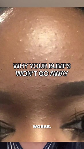 Closed Comedones: The Real Reason Your Bumps Won't Go Away