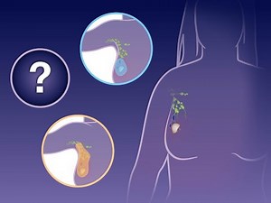 Omitting Axillary Dissection in Breast Cancer | NEJM
