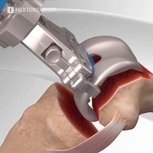 18K views · 222 reactions | Cirugia de artroplastia total de rodilla. #Repost from @fisiocomevidencia | Fisioterapia en Movimiento | Facebook