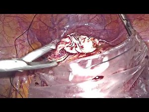 Dermoid Cyst Excision