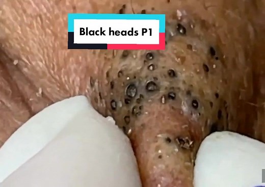 thebestblackhead on TikTok