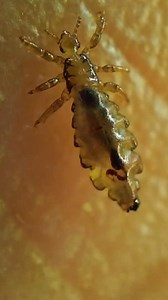 This is a Head Lice (Pediculus humanus capitis) #Lice #PediculusHumanusCapitis #AsmrVideo #viral | Ahmad