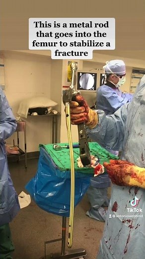 Femoral intramedullary nail