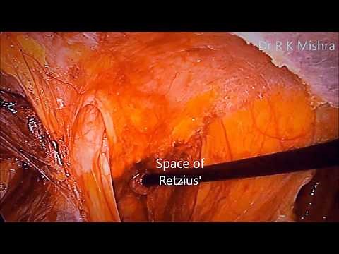 Laparoscopic Inguinal Hernia Surgery Explained Step by Step