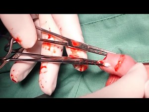 Circumplast Infant Male Circumcision Training Video