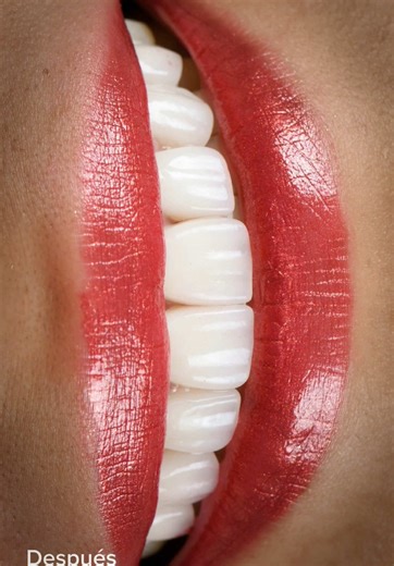 ✨ Smile Makeover Success! ✨ @Dr. Julio Morales, DMD at O2 Dental Group worked magic with this amazing Invisalign and veneer transformation! This patient started her journey with Invisalign to align her teeth, and once her smile was in perfect position, we completed the transformation with stunning veneers. The result? A radiant, confident smile she absolutely loves! 💖 Her patience and commitment truly paid off, and we couldn’t be more excited to see her glowing with happiness! Ready for your ow