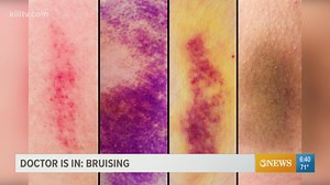 Your bruises tell a story about your body and the best way to treat the nasty and sometimes painful purplish, blue, & yellow  marks