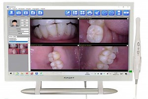 [Hot Item] Professional Dental Diagnostics Monitor System with Intraoral Camera