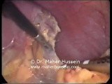 Left Adrenalectomy - Laparoscopic Approach • Video • MEDtube.net