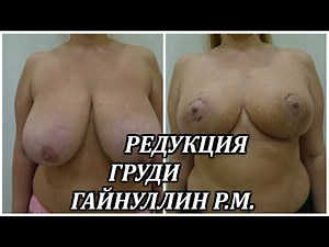 Mammoplasty reduction.The breast reduction.Plastic surgeon Gainullin R M