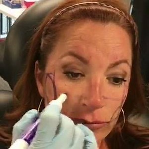 Showing AAFE protocol for Cheek enhancements and mid-face volumization - it takes careful planning for the best results. Best.Training.Ever. Sign up for a course today at www.facialesthetics.org, 800 952-0521 or email info@facialesthetics.org today! BIG month end saving ending Monday so contact us today! If you are a patient, go to our website and find an AAFE member near you! | American Academy of Facial Esthetics | Facebook