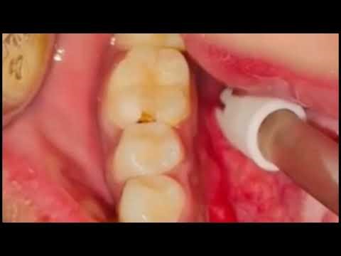 Tooth Filling Procedure | GIC Filling | Dentistry - #006