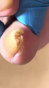 Pedicure for Long Toenails with Fungus Build-Up and Fungus Treatment Q091 #pedicure #nails #nailcare #ingrownnail #toenailfungus Disclaimer: This video contains clips collected from various sources. Full credit goes to the original Chinese creators. This content is used for educational and monetization purposes only. All rights belong to their respective owners. | Quranic Life