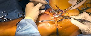 Femoral Artery Cut-Down and Proximal Anastomosis Procedure (Cadaver) | Journal of Medical Insight
