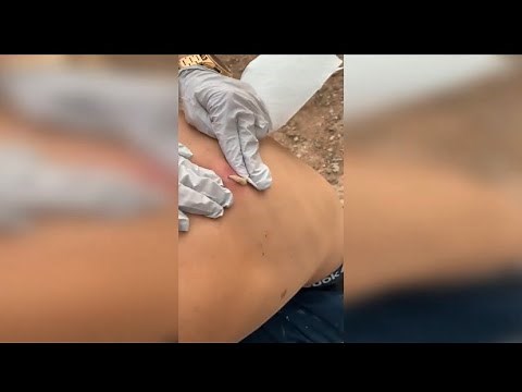 Best cyst and pimple pop compilation