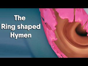 educational content - Annular (Ring-Shaped) Hymen Explained: Facts, Myths, and Science