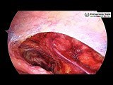 TAPP Inguinal Hernia Repair by Ipsilateral Port • Video • MEDtube.net