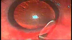 Corneal Staining in Manual Small Incision Cataract Surgery (MSICS) - Eyetube
