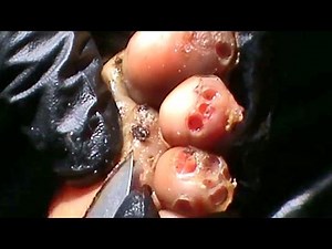 Mordecai's Jigger Removal Extended Cut! - Trypophobia Toes! 😰🎥