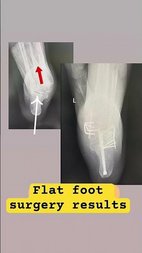 Flat foot surgery results #flatfoot #flatfoottreatment #flatfeet