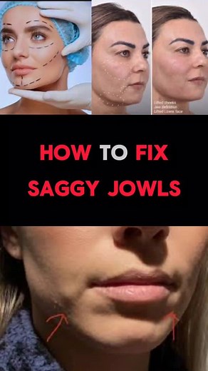 Simple Ways On How To Fix Saggy Jowls . Ultherapy is a non-invasive cosmetic procedure for tightening and lifting skin on the face, neck, and chest. It is commonly used to improve sagging jowls #goodafrica #gratitude #jowls #saggyjowls #healthyliving #yogatips | Nurse Goody Africa
