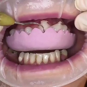 3.7K views · 23 reactions | DENTAL VENEERS this is a permanent fix...