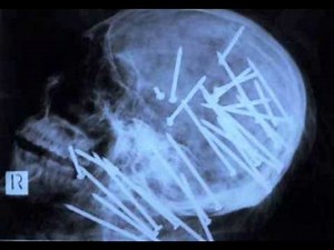 20 Strangest Things Found in an X-Ray