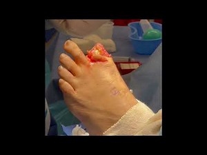 Toe Amputation