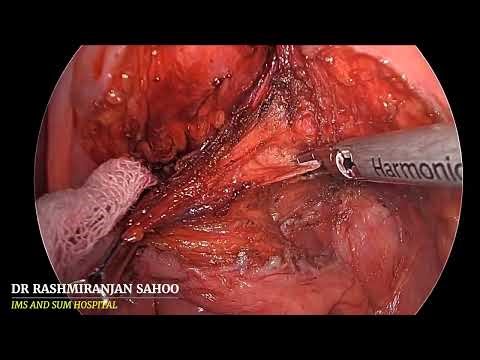 Laparoscopic Ventral mesh rectopexy