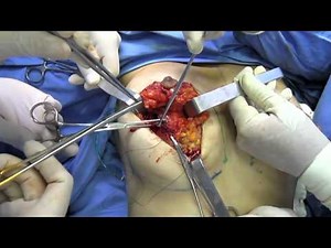 The Periareolar Augmentation Mastopexy (PAM) Method