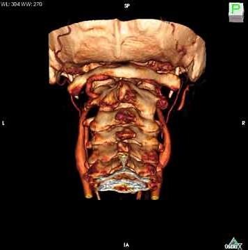 椎骨動脈の解剖学的変異 / anomaly of vertevral artery / 3D image with Osirix